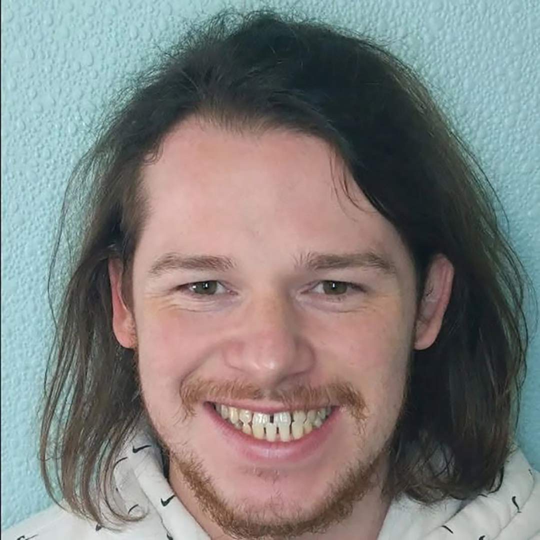 Patient smile before treatment
